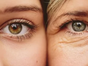 درمان چروک چشم با لیزر فوتونا